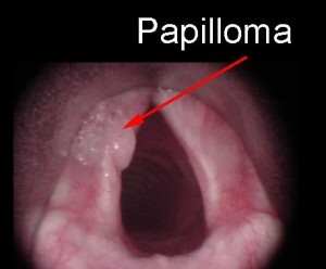 Папиллома гортани