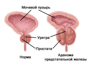 Аденома простаты