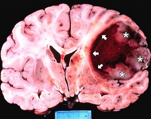 Запущенная глиома мозга