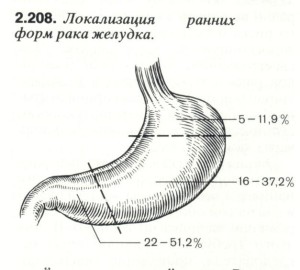 Классификация рака желудка