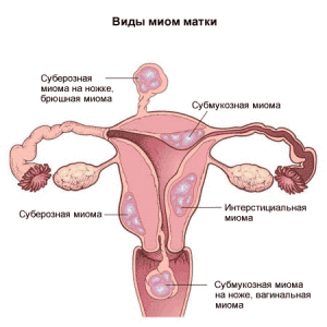 Миомы матки