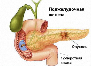 Аденокарцинома поджелудочной железы