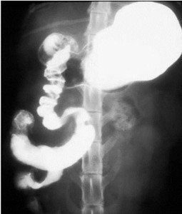 Рентгенография желудка