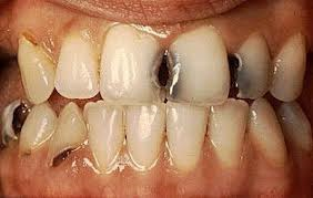 Лечение криозных зубов - профилактика рака