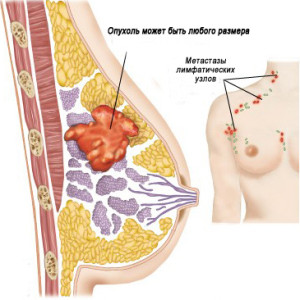 Опухоль молочной железы