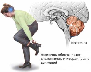 Потеря координации движения - симптом опухоли мозжечка