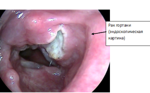 Рак гортани - эндоскопическая картина