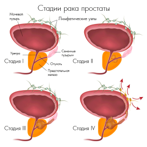 Стадии рака простаты