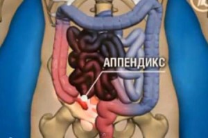 Опухоль аппендикса