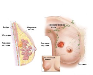 Симптомы рака молочной железы