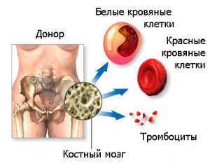 Рак костного мозга