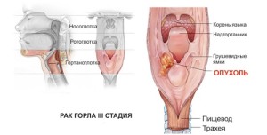 Рак горла 3-я стадия