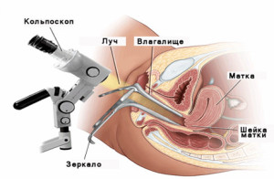 Диагностика рака влагалища