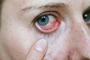 Рак глаза симптомы