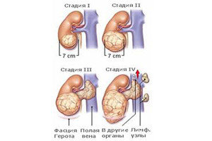 Стадии рака почек
