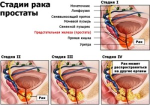 Стадии рака простаты