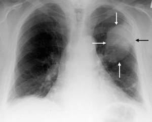 Рентген при раке легких