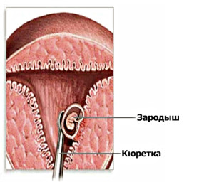 Аборт - одна из причин болезни