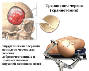 Фрагментарное удаление черепных костей