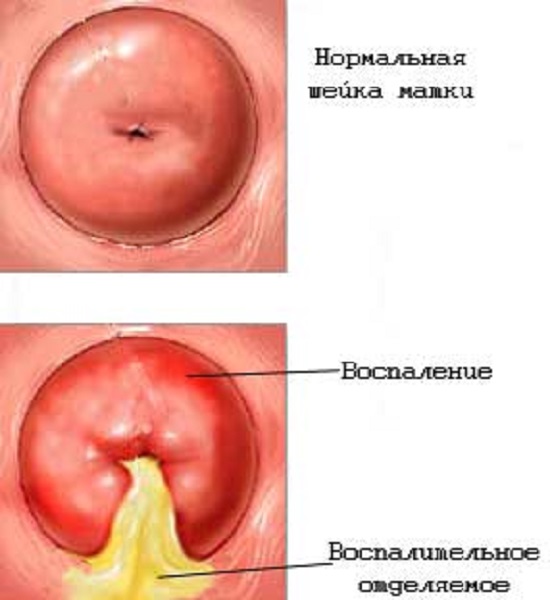 Выделения при патологиях шейки матки