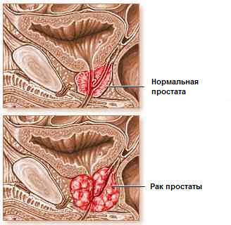 Рак простаты