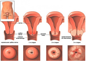 Стадии рака шейки матки