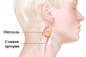 Опухоль на шее справа