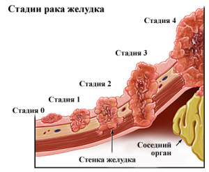 Стадии рака прямой кишки