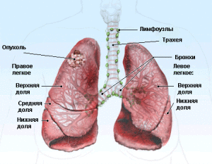 Опухоль в правом легком