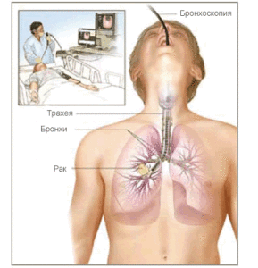 Бронхоскопия - диагностика рака легких