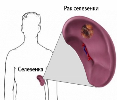 Рак селезенки